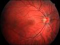 Открытие американских ученых в лечении дегенеративных заболеваний сетчатки глаза