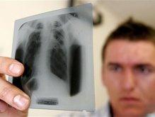 Каждый час 4 украинца заболевают туберкулезом