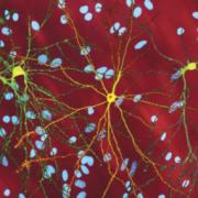 Фактор роста уменьшил гибель нейронов при болезни Хантингтона