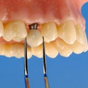 Когда зуб искусственный становится «родным»