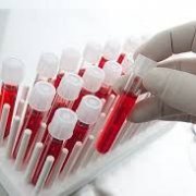 Новый анализ крови помогает в диагностике и лечении артрита
