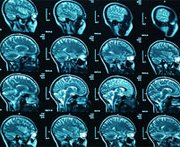 Истоки хладнокровия в мозге связаны с шизофренией