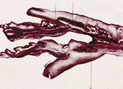 Общая методика лечения тромбофлебита вен нижних конечностей