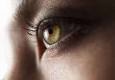Использование белка Robo4 в лечении дегенеративных заболеваний глаза