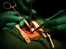 Лео Бокерия провeл операцию на открытом сердце